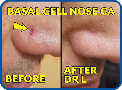Basal Cell On Nose