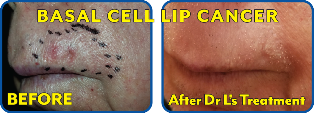 Basal Cell Lip Cancer