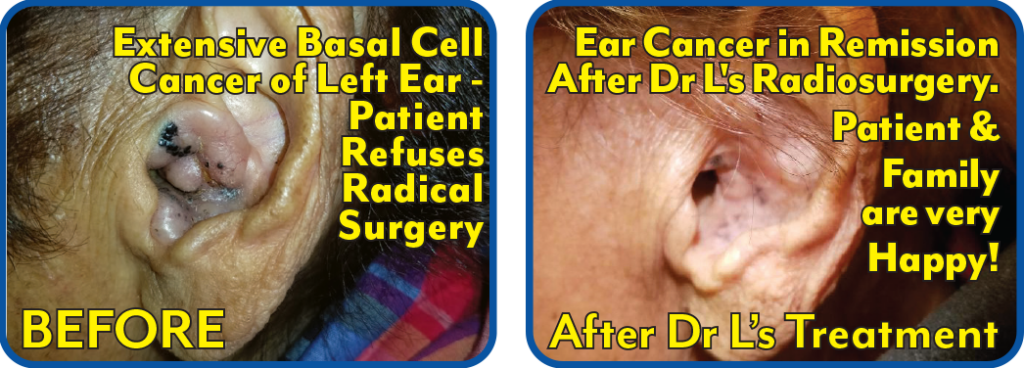 Ear Basal Cell Cancer