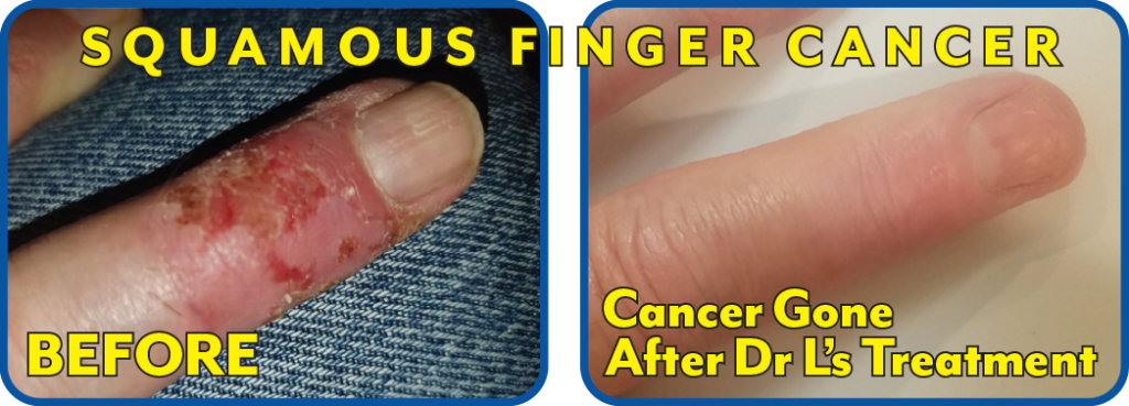 Squamous Finger Cancer