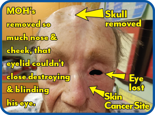 Extensive nose MOH's required skull bone graft & resulted in blindness when man couldn’t close eye anymore! So sad.