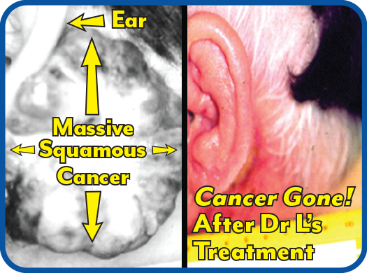Massive skin cancer, much larger than ear, she chose Dr L’s treatment resulting in complete cancer disappearance!