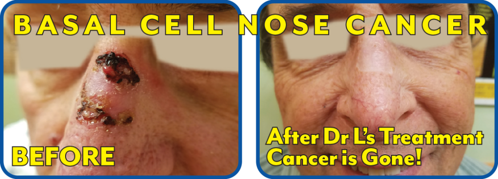Basal Cell Nose Cancer