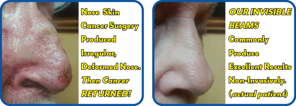 Nose Skin Cancer Surgery