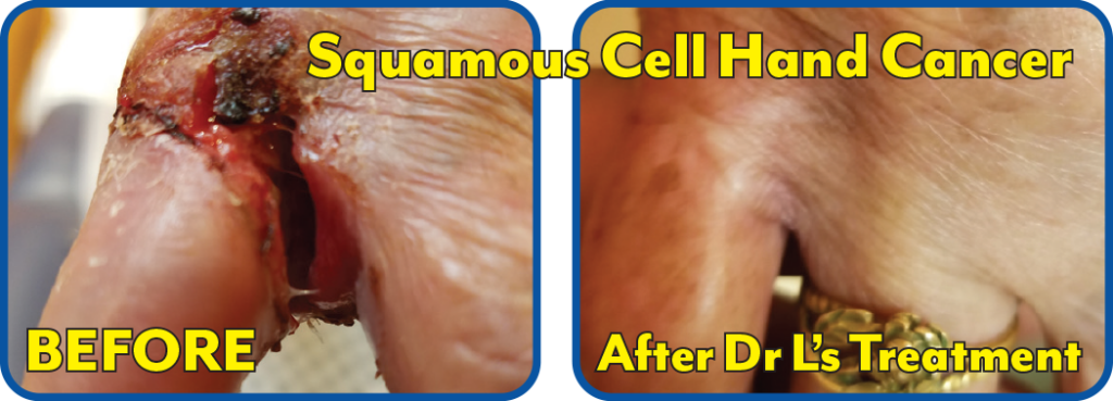 Squamous Cell HAnd Cancer