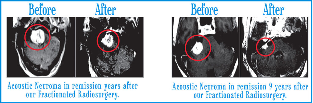 Acoustic Neuromas Before After 1