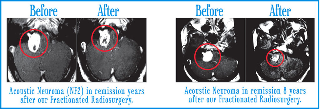 Acoustic Neuromas Before After 2