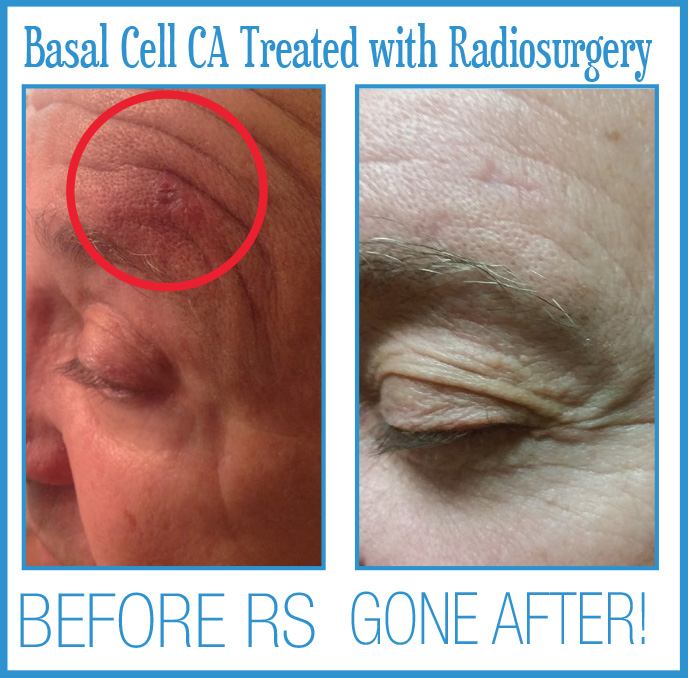 Basal Cell Cancer Before After Radiosurgery