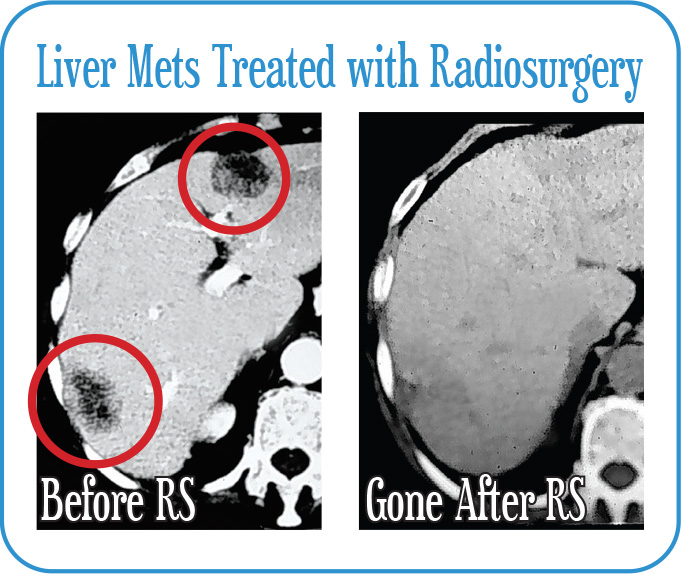 Liver Mets Treated with Radiosurgery