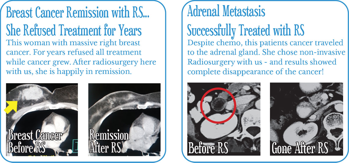 Before and After Radiosurgery