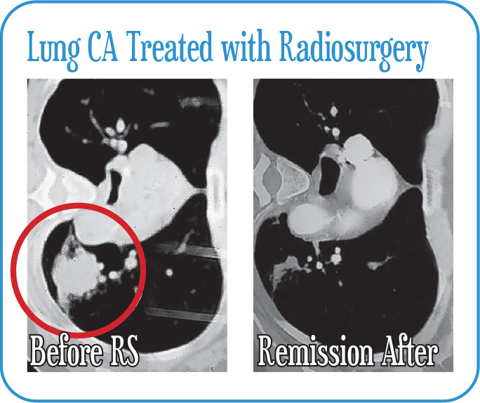 Lung CA Treated with Radiosurgery
