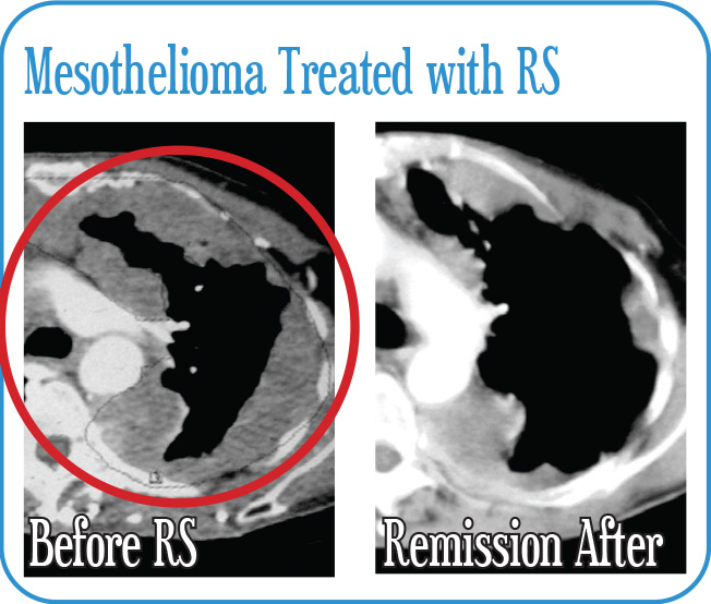 Mesothelioma Treated with RS