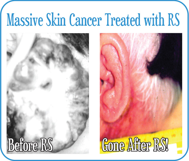 Massive Skin Cancer Treated with RS