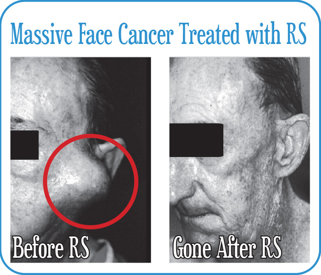 Massive Face Cancer Treated with RS