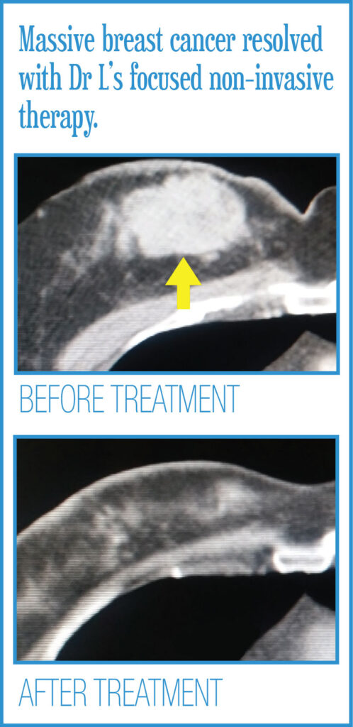 Body Radiosurgery Before After