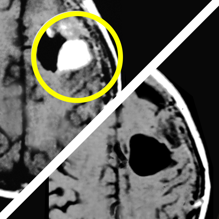 Brain-Cancer-Before-&-After