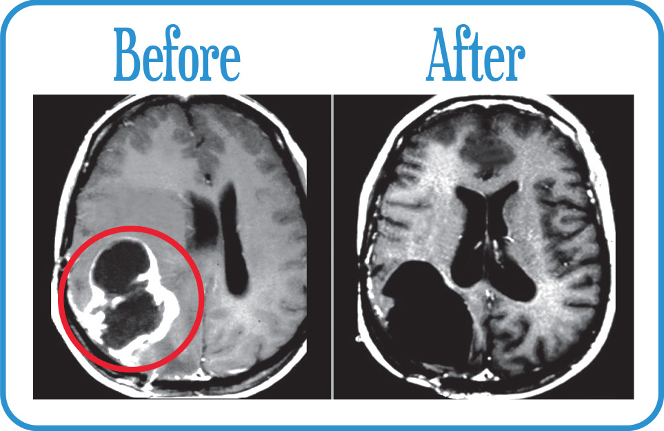 Recurrent Glioblastoma in remission 6 years after our FSR.