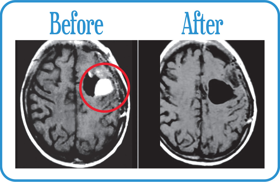 Recurrent Glioblastoma in complete remission after our Radiosurgery.