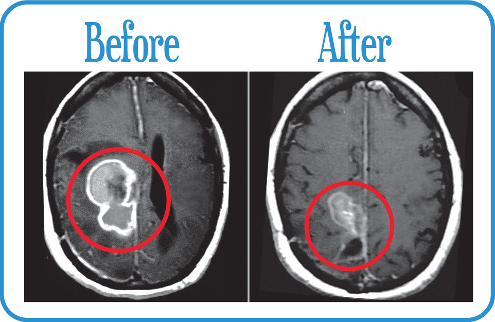 Glioblastoma in remission 1 year after our Radiosurgery.