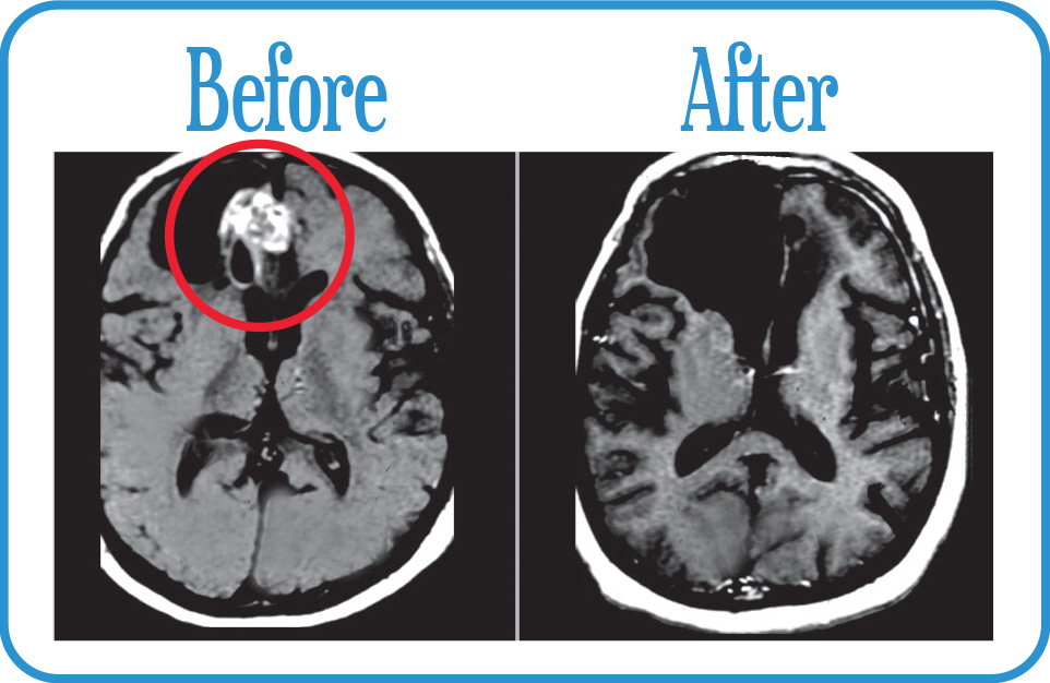 Recurrent Glioblastoma 20 years after our FSR - cancer free.