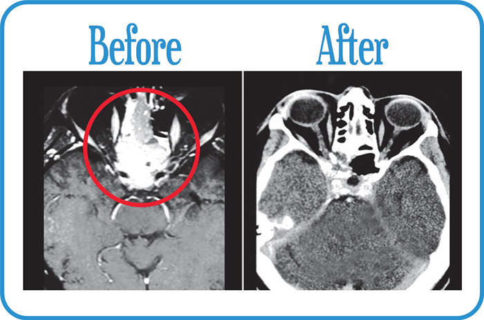 Nasopharynx Cancer in remission 5 years after our Fractionated Radiosurgery.