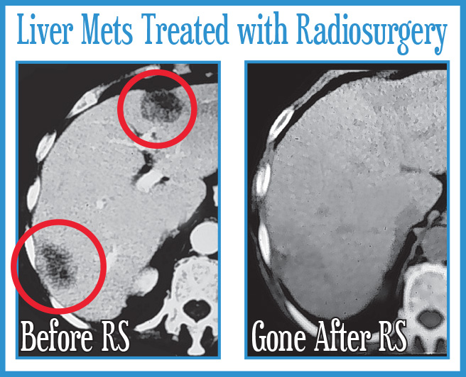Liver Metastasis Treated with Radiosurgery