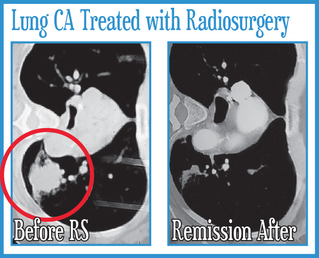 Lung Cancer Treated with Radiosurgery