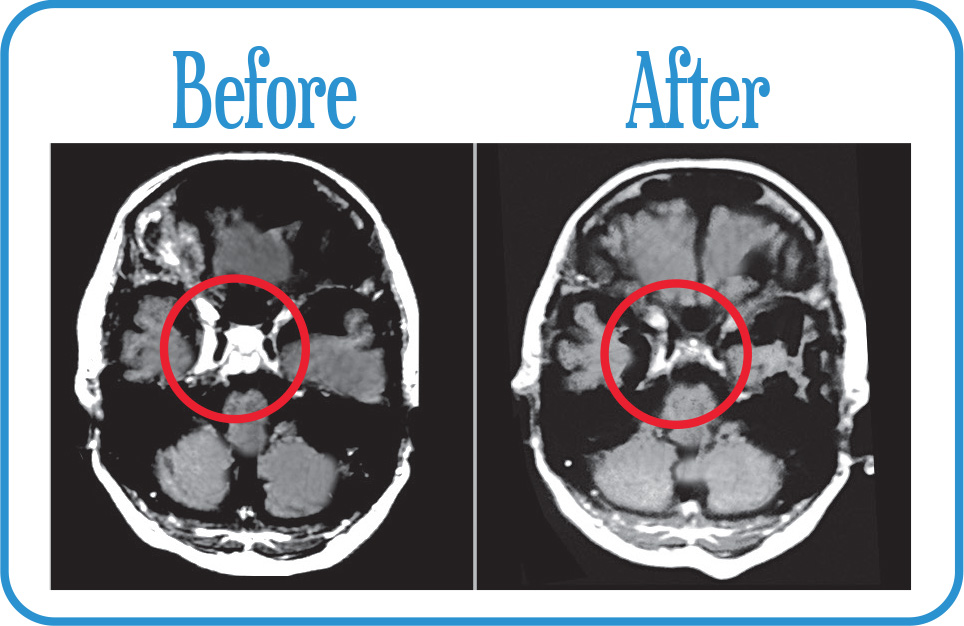 Meningioma in remission years after our Fractionated Radiosurgery.
