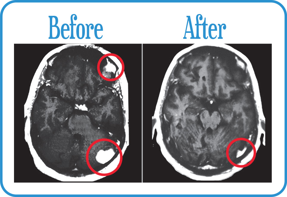 Multifocal Brain Metastases in remission after our Fractionated Radiosurgery.