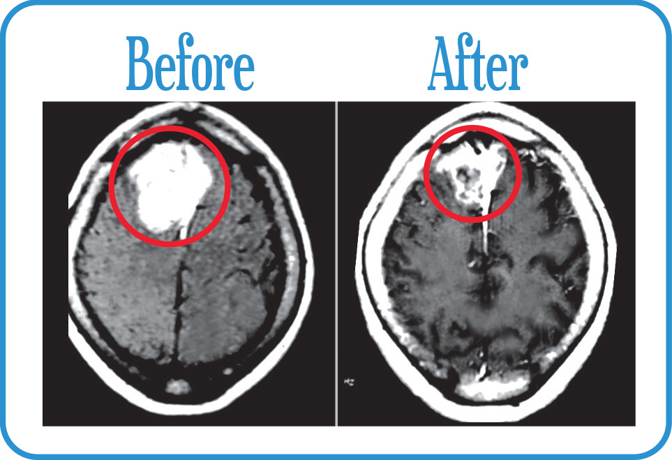 Large Brain Metastasis in remission after our Fractionated Radiosurgery.