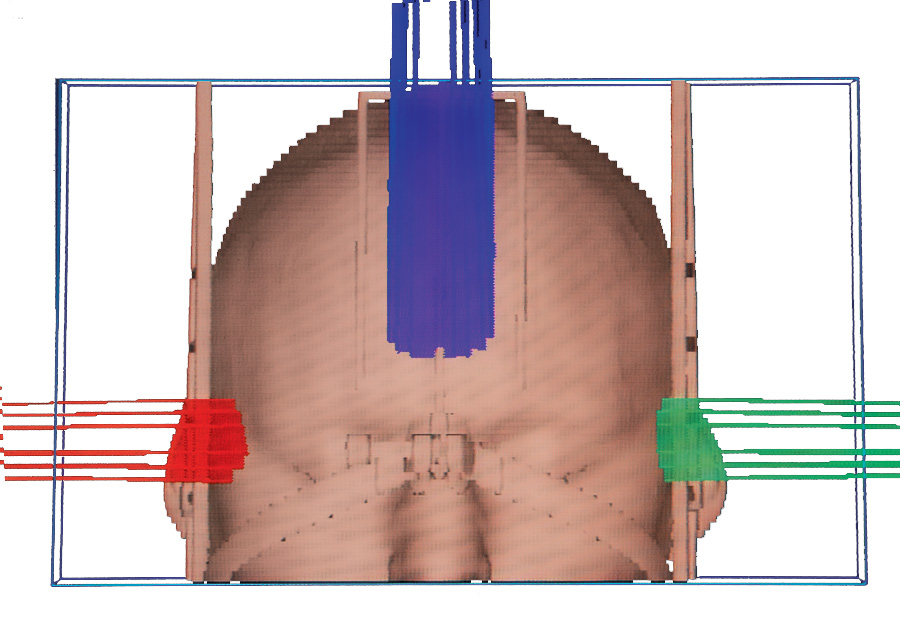Stereotactic Radiosurgery Head Frame