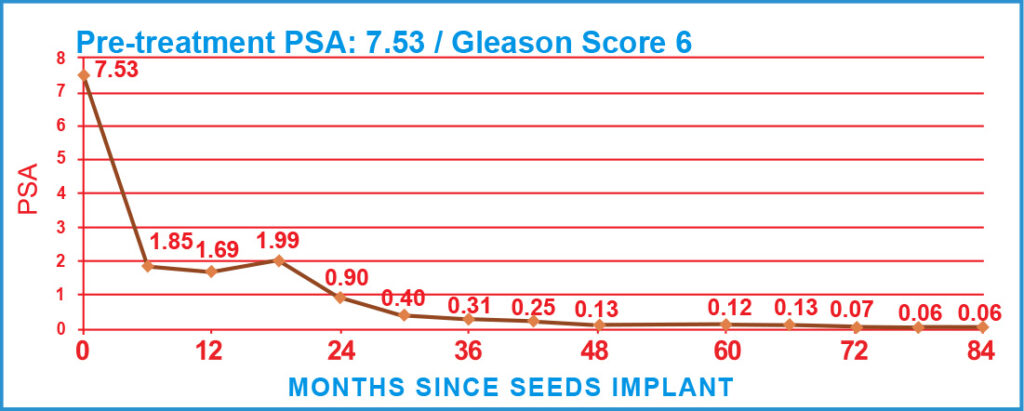 Pre-treatment PSA: 7.53 / Gleason Score 6