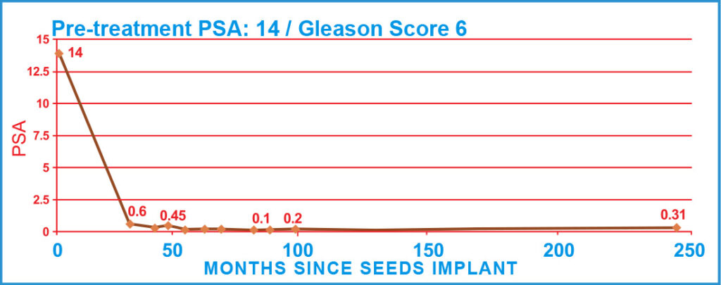 Pre-treatment PSA: 14 / Gleason Score 6