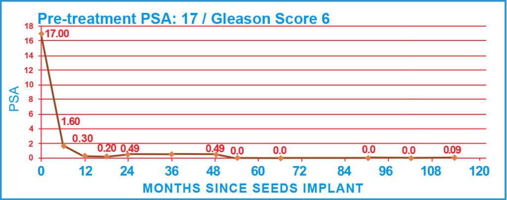 Pre-treatment PSA: 17 / Gleason Score 6