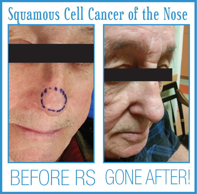 Squamous Cell Cancer Before After Radiosurgery